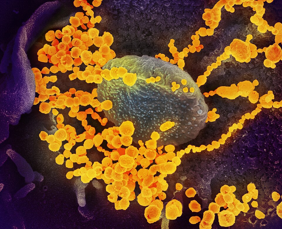 SARS-CoV-2 in a colorized electron micrograph