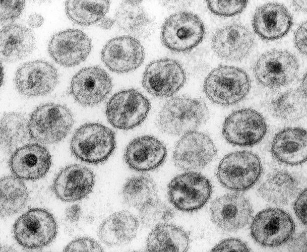 HIV-1 particles in an electron micrograph